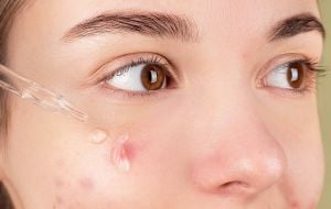 Conheça os efeitos na pele causados pela desregulação dos hormônios