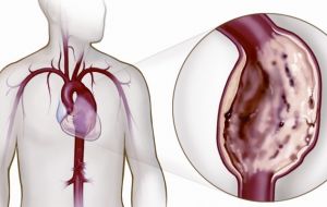 Aneurisma da aorta torácica: entenda o que é a doença que o Otaviano Costa descobriu